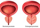 Prostate Enlargement and it's signs