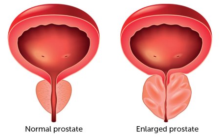 Prostate Enlargement and it's signs