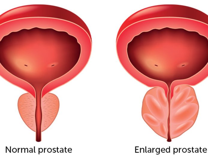 Prostate Enlargement and it's signs